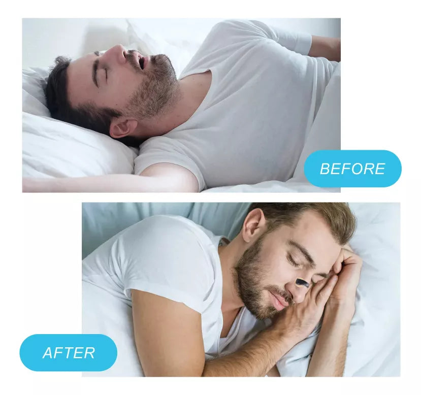 Kit De 30 Kits De Dilatadores Respiratorios Nasales