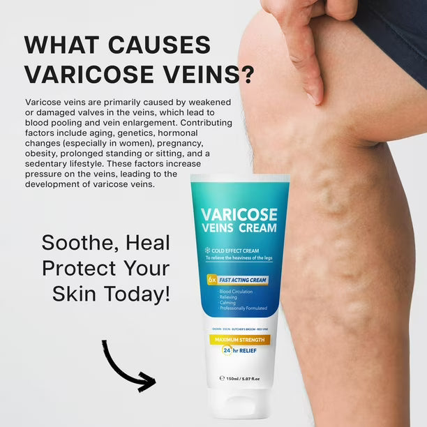 Crema Itlufly Para Venas Varicosas: Alivio Y Eficacia