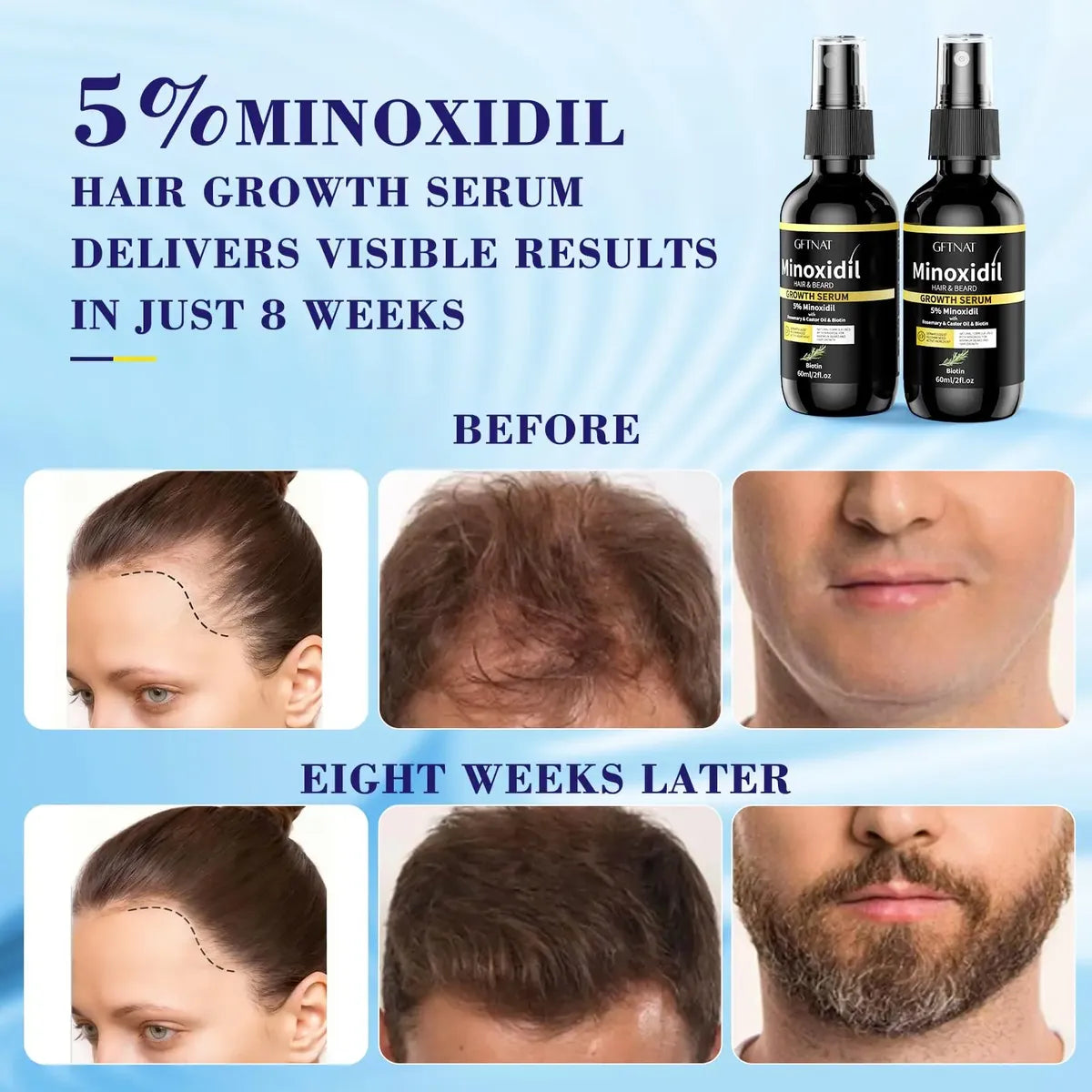 Solución De Pérdida De Cabello En Aerosol Con 5% De Minoxidil