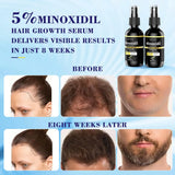 Solución De Pérdida De Cabello En Aerosol Con 5% De Minoxidil